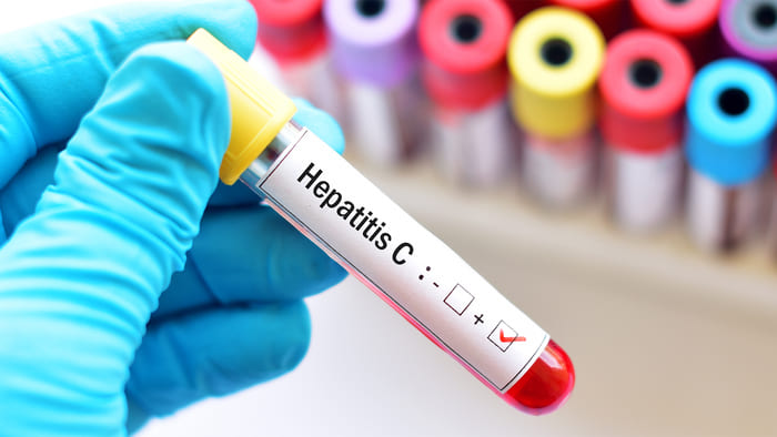 Hepatit C Virüs Enfeksiyonu